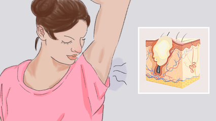 常州治疗腋臭去哪家医院好？狐臭治疗的全面指南